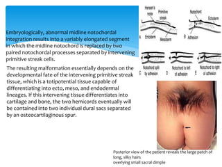 Posterior view of the patient reveals the large patch of
long, silky hairs
overlying small sacral dimple
Embryologically, abnormal midline notochordal
integration results into a variably elongated segment
in which the midline notochord is replaced by two
paired notochordal processes separated by intervening
primitive streak cells.
The resulting malformation essentially depends on the
developmental fate of the intervening primitive streak
tissue, which is a totipotential tissue capable of
differentiating into ecto, meso, and endodermal
lineages. If this intervening tissue differentiates into
cartilage and bone, the two hemicords eventually will
be contained into two individual dural sacs separated
by an osteocartilaginous spur.
 