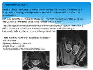 consists of two hemicords contained within individual dural tubes, separated by a
bony or osteocartilaginous septum that extends from the vertebral body to the
neural arches
Clinically, patients often display a hairy tuft lying high relatively cephalad along the
back, which is considered to be a very reliable clinical marker
The radiological hallmark is the osseous or osteocartilaginous septum (the “spur”),
which divides the spinal canal into two separate halves, each containing an
independent dural tube, in turn containing a hemicord.
There may be a number of associated fi ndings in
this condition.
Hydromyelia is very common
A tight fi lum terminale
hemimyelocele or hemimyelomeningocele.
Diastematomyelia type I
 