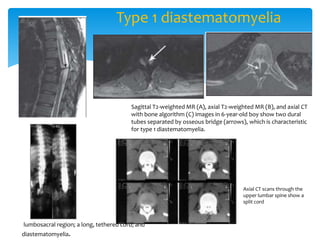 Type 1 diastematomyelia
Sagittal T2-weighted MR (A), axial T2-weighted MR (B), and axial CT
with bone algorithm (C) images in 6-year-old boy show two dural
tubes separated by osseous bridge (arrows), which is characteristic
for type 1 diastematomyelia.
Axial CT scans through the
upper lumbar spine show a
split cord
lumbosacral region; a long, tethered cord; and
diastematomyelia.
 