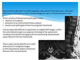 Diastematomyelia type II is embryologically a less severe form than type I. The basic
difference is that there is not an osteocartilaginous spur to divide the spinal canal.
Three variants of diastematomyelia type II exist,
• absence of a septum
• presence of an intervening fi brous septum
• partial cord splittingdural tube housing both hemicords
may be especially difficult to appreciate on sagittal MR images, where
the only indicative sign is an apparent thinning of the spinal cord
resulting from partial averaging with the intervening subarachnoid
space between the two hemicords.
These septa may be identifi ed on axial
and coronal T2-weighted images
as thin hypointense stripes interposed
between the two hemicords
 