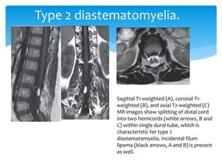 Type 2 diastematomyelia.
Sagittal T1-weighted (A), coronal T1-
weighted (B), and axial T2-weighted (C)
MR images show splitting of distal cord
into two hemicords (white arrows, B and
C) within single dural tube, which is
characteristic for type 2
diastematomyelia. Incidental filum
lipoma (black arrows, A and B) is present
as well.
 