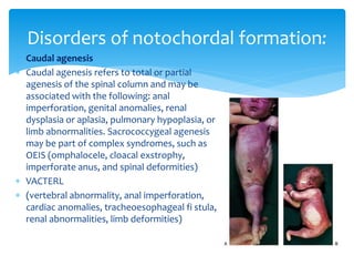  Caudal agenesis
 Caudal agenesis refers to total or partial
agenesis of the spinal column and may be
associated with the following: anal
imperforation, genital anomalies, renal
dysplasia or aplasia, pulmonary hypoplasia, or
limb abnormalities. Sacrococcygeal agenesis
may be part of complex syndromes, such as
OEIS (omphalocele, cloacal exstrophy,
imperforate anus, and spinal deformities)
 VACTERL
 (vertebral abnormality, anal imperforation,
cardiac anomalies, tracheoesophageal fi stula,
renal abnormalities, limb deformities)
Disorders of notochordal formation:
 