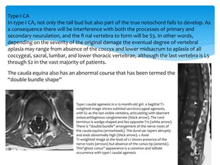 Type-I CA
In type-I CA, not only the tail bud but also part of the true notochord fails to develop. As
a consequence there will be interference with both the processes of primary and
secondary neurulation, and the fi nal vertebra to form will be S3. In other words,
depending on the severity of the original damage the eventual degree of vertebral
aplasia may range from absence of the coccyx and lower midsacrum to aplasia of all
coccygeal, sacral, lumbar, and lower thoracic vertebrae, although the last vertebra is L5
through S2 in the vast majority of patients.
The cauda equina also has an abnormal course that has been termed the
“double bundle shape”
Type-I caudal agenesis in a 15-month-old girl. a Sagittal T1-
weighted image shows subtotal sacrococcygeal agenesis,
with S2 as the last visible vertebra, articulating with aberrant
osteocartilaginous conglomerate (black arrow). The cord
terminus is wedge-shaped and lies opposite T12 (white arrow).
There is “double bundle” arrangement of the nerve roots of
the cauda equina (arrowheads). The dural sac tapers abruptly
and ends abnormally high (thick arrow). c Axial
T1-weighted image at the level of L1 shows presence of the
nerve roots (arrows) but absence of the conus tip (asterisk).
This“ghost conus” appearance is a common and telltale
occurrence with type-I caudal agenesis
 