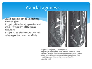 Caudal agenesis
, Sagittal T2-weighted (A) and sagittal T1-
weighted (B) MR images in show agenesis of sacrum. Conus
medullaris is high in position and wedge shaped (arrow) due to
abrupt termination. These findings are characteristic of type
1 caudal agenesis. Distal cord syrinx (arrowhead) is
present as well.
Caudal agenesis can be categorized
into two types.
In type 1, there is a high position and
abrupt termination of the conus
medullaris.
In type 2, there is a low position and
tethering of the conus medullaris
 