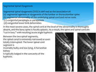Segmental Spinal Dysgenesis
Segmental spinal dysgenesis (SSD) is defi ned as the association of:
(a) segmental agenesis or dysgenesis of the lumbar or thoracolumbar spine
(b) segmental abnormality of the underlying spinal cord and nerve roots
(c) congenital paraplegia or paraparesis
(d) congenital lower limb deformities
In the most severe cases, the spinal cord at the level of the abnormality is thoroughly
absent, and the bony spine is focally aplastic. As a result, the spine and spinal cord are
“cut in two,” with resulting acute angle kyphosis
Between the two spinal segments,
the spinal canal is extremely narrowed or even
totally interrupted. The lower spinal cord
segment is
invariably bulky and low-lying. A horseshoe
kidney
is typically lodged in the concavity of the
kyphosis.
 