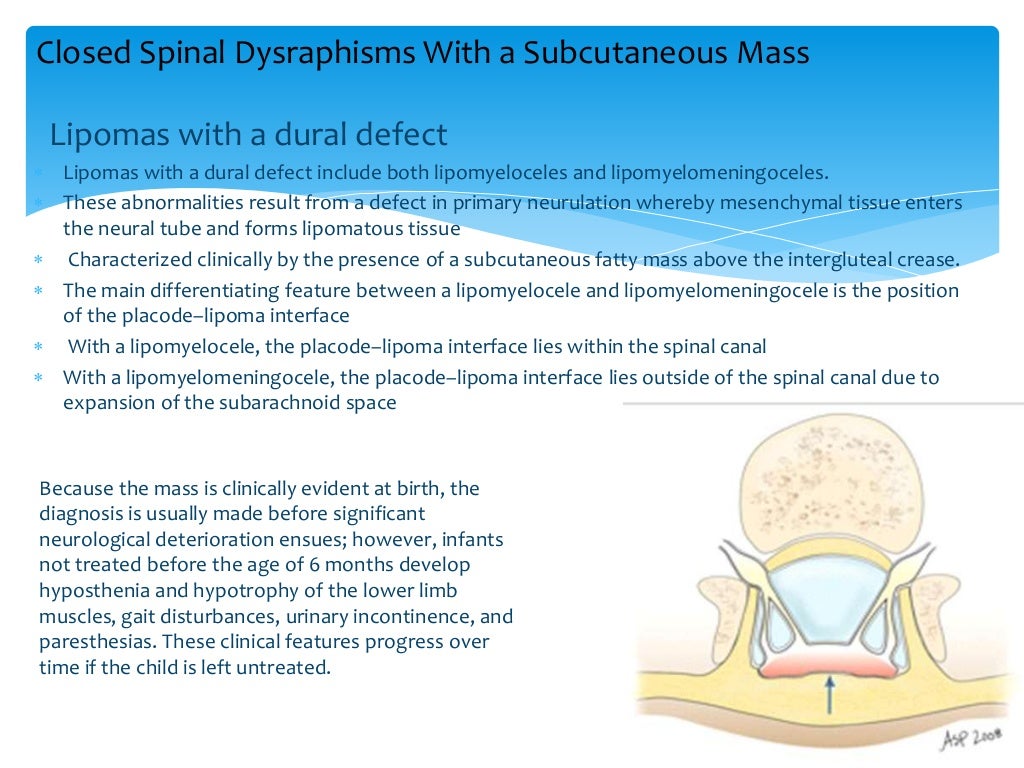 Imaging of spinal dysraphism