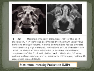 Imaging of spinal trauma | PPTX