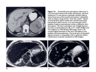 Splenium Ct Imaging of spleen ct and mri | PPTX