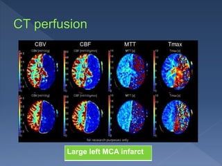 Imaging of early ischemic stroke | PPTX