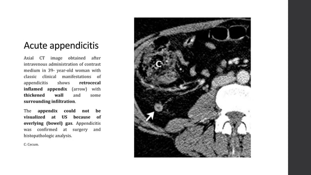 Imaging of Acute Abdomen | PPTX | Digestive Disorders | Diseases and ...