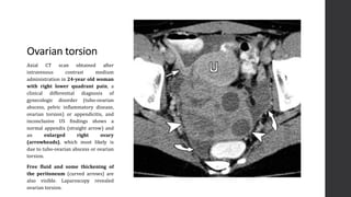 Imaging of Acute Abdomen | PPTX