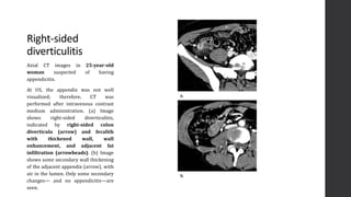 Imaging of Acute Abdomen | PPTX
