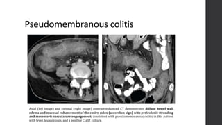 Imaging of Acute Abdomen | PPTX