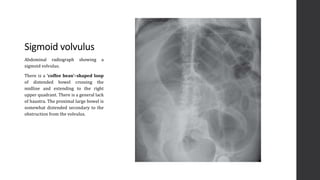 Volvulus Radiograph Imaging of Acute Abdomen | PPTX