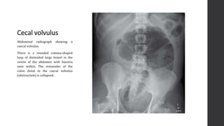 Volvulus Radiograph Imaging of Acute Abdomen | PPTX