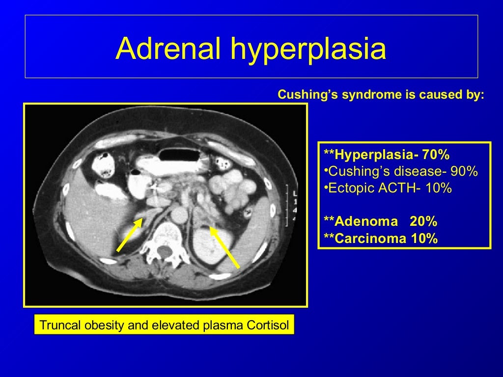 Imaging of the adrenal glands