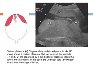 Bilobed placenta. (a) Diagram shows a bilobed placenta. (b) US
image shows a bilobed placenta. The two lobes of the placenta
(P1 and P2) are separated by a thin bridge of placental tissue that
covers the internal os. In this case, the umbilical cord (arrowhead)
inserts into the bridge of tissue.
 