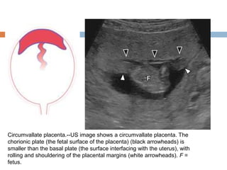 Circumvallate placenta.--US image shows a circumvallate placenta. The
chorionic plate (the fetal surface of the placenta) (black arrowheads) is
smaller than the basal plate (the surface interfacing with the uterus), with
rolling and shouldering of the placental margins (white arrowheads). F =
fetus.
 