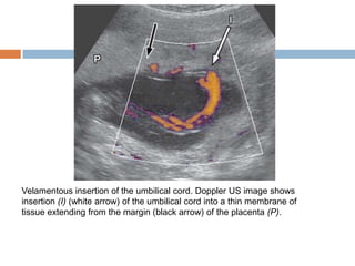 Velamentous insertion of the umbilical cord. Doppler US image shows
insertion (I) (white arrow) of the umbilical cord into a thin membrane of
tissue extending from the margin (black arrow) of the placenta (P).
 