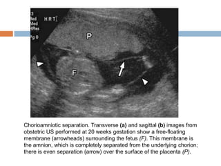 Chorioamniotic separation. Transverse (a) and sagittal (b) images from
obstetric US performed at 20 weeks gestation show a free-floating
membrane (arrowheads) surrounding the fetus (F). This membrane is
the amnion, which is completely separated from the underlying chorion;
there is even separation (arrow) over the surface of the placenta (P).
 