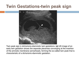 Twin Gestations-twin peak sign




Twin peak sign in dichorionic-diamniotic twin gestations. (a) US image of an
early twin gestation shows the separate placentas converging at the insertion
of the amniotic membrane (arrowhead), forming the so-called twin peak that is
characteristic of a dichorionic-diamniotic gestation.
 