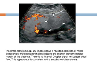 Placental hematoma. (a) US image shows a rounded collection of mixed-
echogenicity material (arrowheads) deep to the chorion along the lateral
margin of the placenta. There is no internal Doppler signal to suggest blood
flow. This appearance is consistent with a subchorionic hematoma.
 