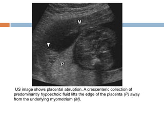 US image shows placental abruption. A crescenteric collection of
predominantly hypoechoic fluid lifts the edge of the placenta (P) away
from the underlying myometrium (M).
 