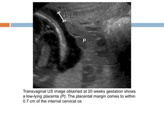 Transvaginal US image obtained at 20 weeks gestation shows
a low-lying placenta (P). The placental margin comes to within
0.7 cm of the internal cervical os
 