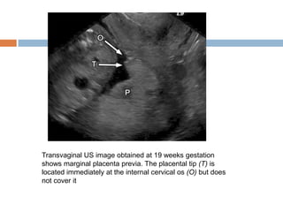 Transvaginal US image obtained at 19 weeks gestation
shows marginal placenta previa. The placental tip (T) is
located immediately at the internal cervical os (O) but does
not cover it
 