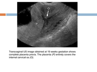 Transvaginal US image obtained at 19 weeks gestation shows
complete placenta previa. The placenta (P) entirely covers the
internal cervical os (O).
 