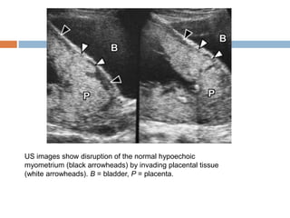 US images show disruption of the normal hypoechoic
myometrium (black arrowheads) by invading placental tissue
(white arrowheads). B = bladder, P = placenta.
 