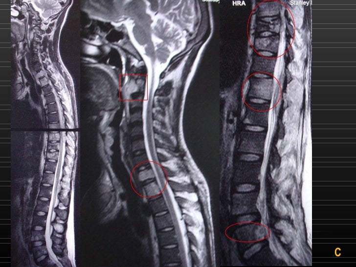 MRI Collapsed Vertebral Bodies