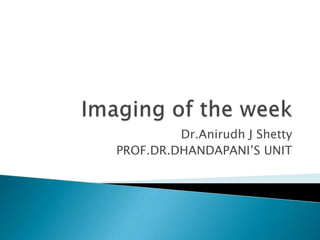 Imaging of the week Dr.Anirudh J Shetty PROF.DR.DHANDAPANI’S UNIT  
