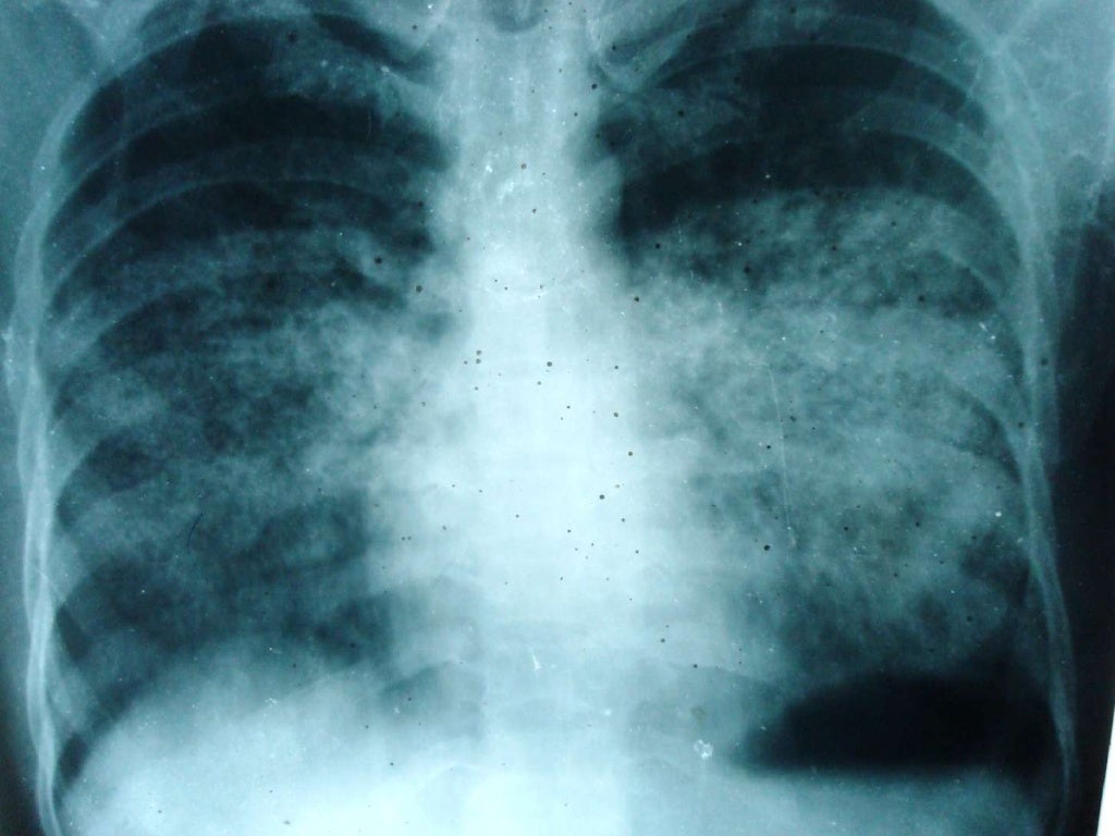 Xray Pneumocystis Pneumonia