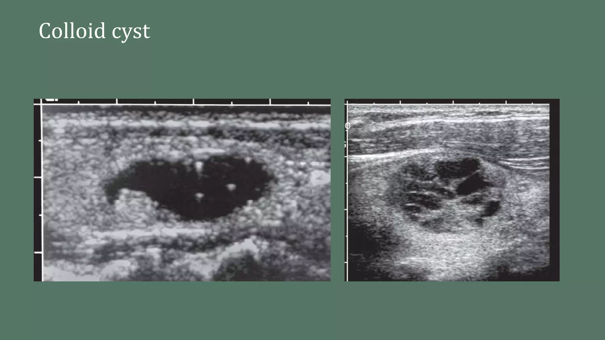 Imaging of thyroid | PPTX