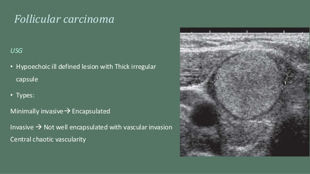 Imaging Of Thyroid