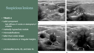 Suspicious lesions
• TIRADS 4:
solid component
high stiffness of nodule on elastographyif
available
markedly hypoechoic nodule
microcalcifications
taller-than-wider shape
microlobulations or irregularmargins
• subclassified as4a, 4b, and later 4c
 
