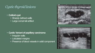 Cystic thyroid lesions
• Colloid cyst
• Sharply defined walls
• Large comet tail artifact
• Cystic Variant of papillary carcinoma
• Irregular walls
• Lobulated margins
• Presence of blood vessels in solid component
 