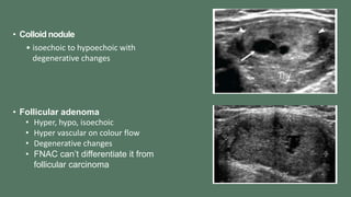 • Colloid nodule
• isoechoic to hypoechoic with
degenerative changes
• Follicular adenoma
• Hyper, hypo, isoechoic
• Hyper vascular on colour flow
• Degenerative changes
• FNAC can’t differentiate it from
follicular carcinoma
 