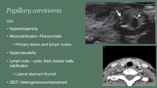 Papillary carcinoma
USG
• Hypoechogenicity
• Microcalcification -Finepunctate
• Primary lesion and lymph nodes
• Hypervascularity
• Lymph node – cystic, thick nodular walls,
calcification
• Lateral aberrant thyroid
• CECT: Heterogeneousenhancement
 