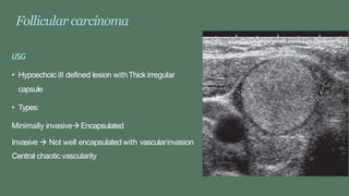 Follicular carcinoma
USG
• Hypoechoic ill defined lesion withThick irregular
capsule
• Types:
Minimally invasiveEncapsulated
Invasive  Not well encapsulated with vascularinvasion
Central chaotic vascularity
 
