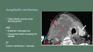 Anaplastic carcinoma
• Fatal- elderly women,long
standing goitre
USG
• Ill defined, heterogenous
• Hypoechoic lesion encasing the
vessels
CT
Extent/ calcification / necrosis
 