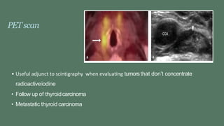 PETscan
• Useful adjunct to scintigraphy when evaluating tumorsthat don’t concentrate
radioactiveiodine
• Follow up of thyroidcarcinoma
• Metastatic thyroid carcinoma
 