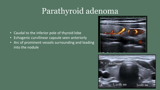 Parathyroid adenoma
• Caudal to the inferior pole of thyroid lobe
• Echogenic curvilinear capsule seen anteriorly
• Arc of prominent vessels surrounding and leading
into the nodule
 