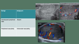 Benign Malignant
Sonoluscent peripheral
halo
Absent
Peripheral vascularity Intranodal vascularity
 