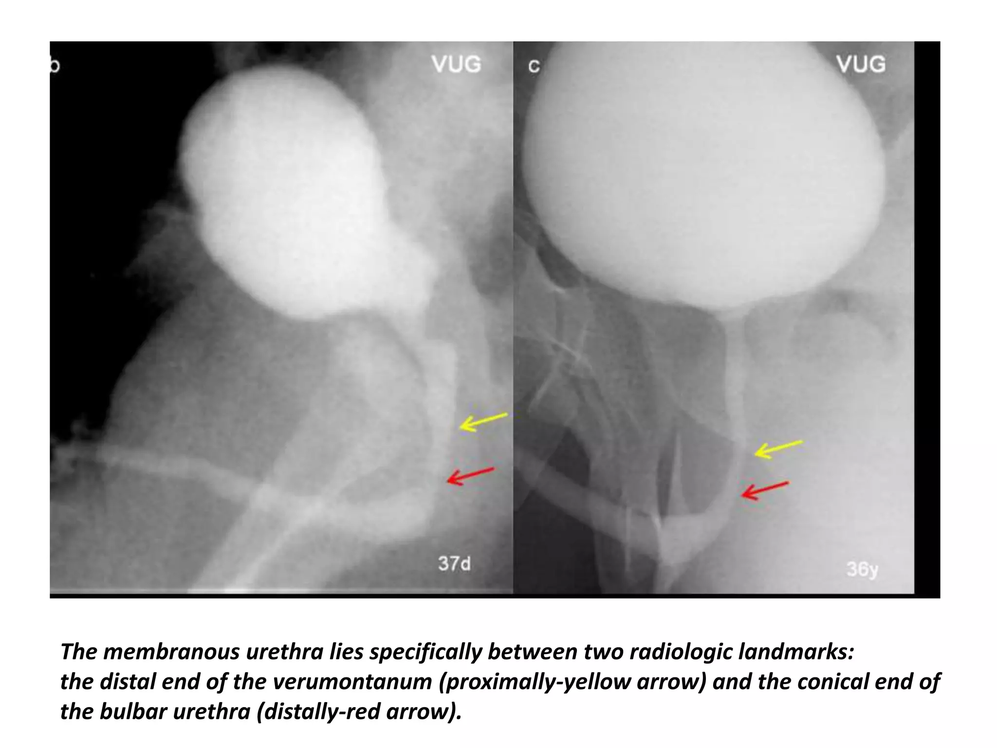 The membranous urethra lies specifically between two radiologic landmarks:
the distal end of the verumontanum (proximally-yellow arrow) and the conical end of
the bulbar urethra (distally-red arrow).
 