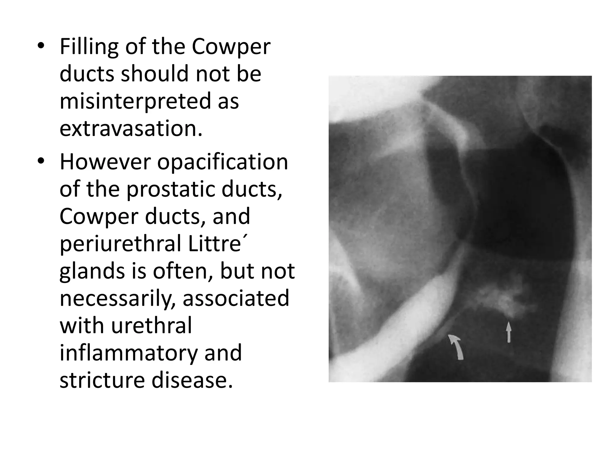 • Filling of the Cowper
ducts should not be
misinterpreted as
extravasation.
• However opacification
of the prostatic ducts,
Cowper ducts, and
periurethral Littre´
glands is often, but not
necessarily, associated
with urethral
inflammatory and
stricture disease.
 