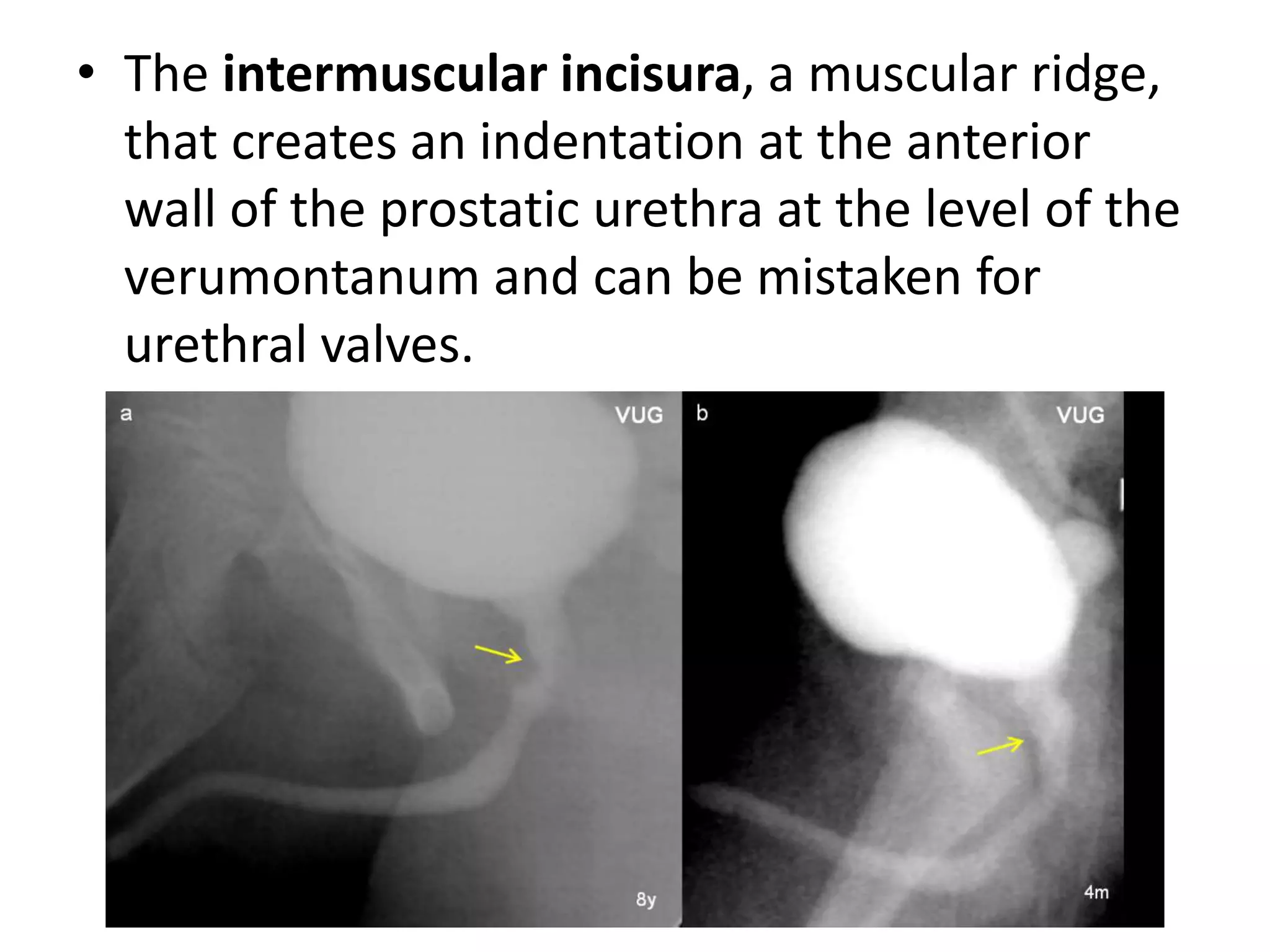 • The intermuscular incisura, a muscular ridge,
that creates an indentation at the anterior
wall of the prostatic urethra at the level of the
verumontanum and can be mistaken for
urethral valves.
 