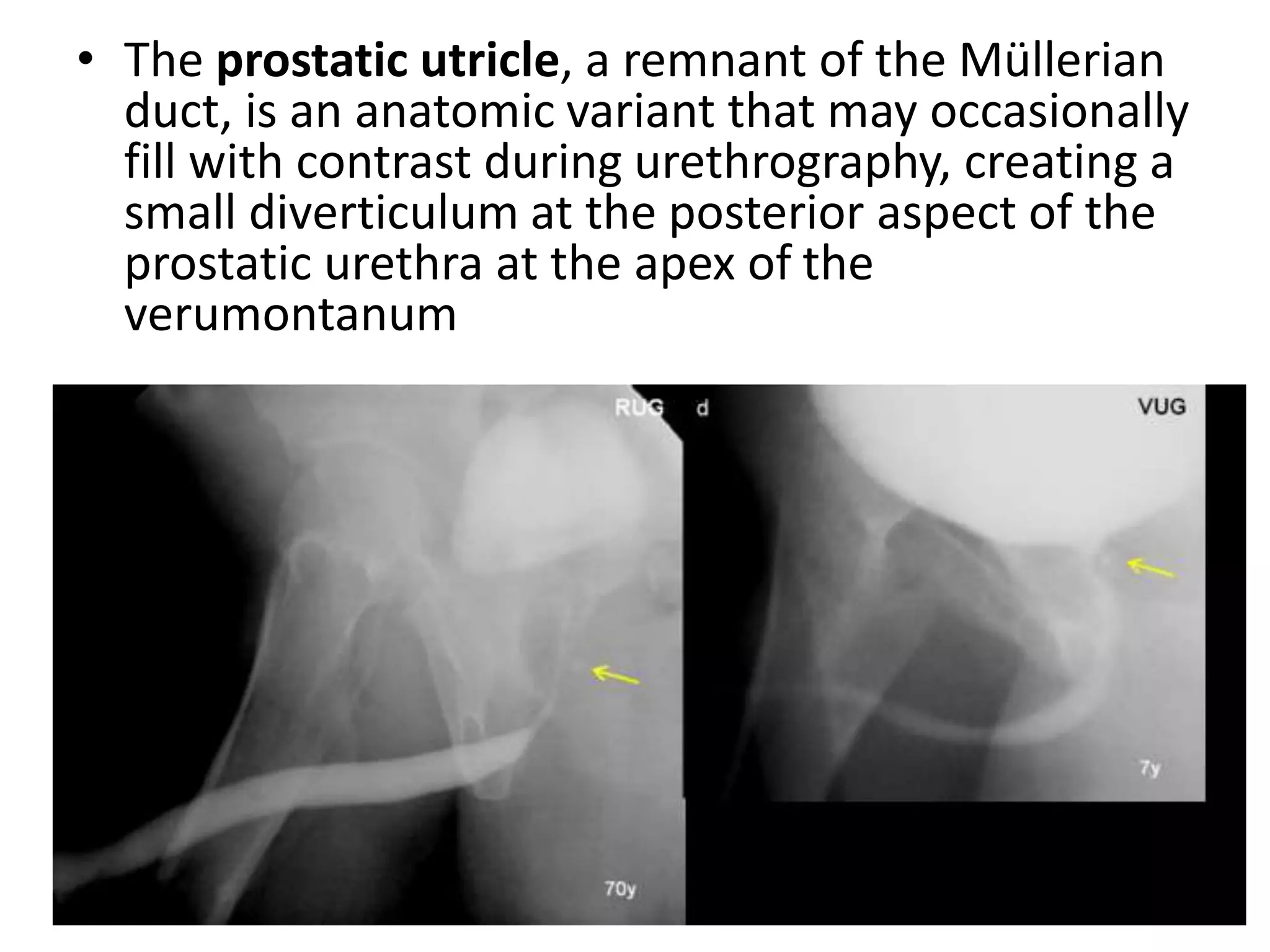 • The prostatic utricle, a remnant of the Müllerian
duct, is an anatomic variant that may occasionally
fill with contrast during urethrography, creating a
small diverticulum at the posterior aspect of the
prostatic urethra at the apex of the
verumontanum
 