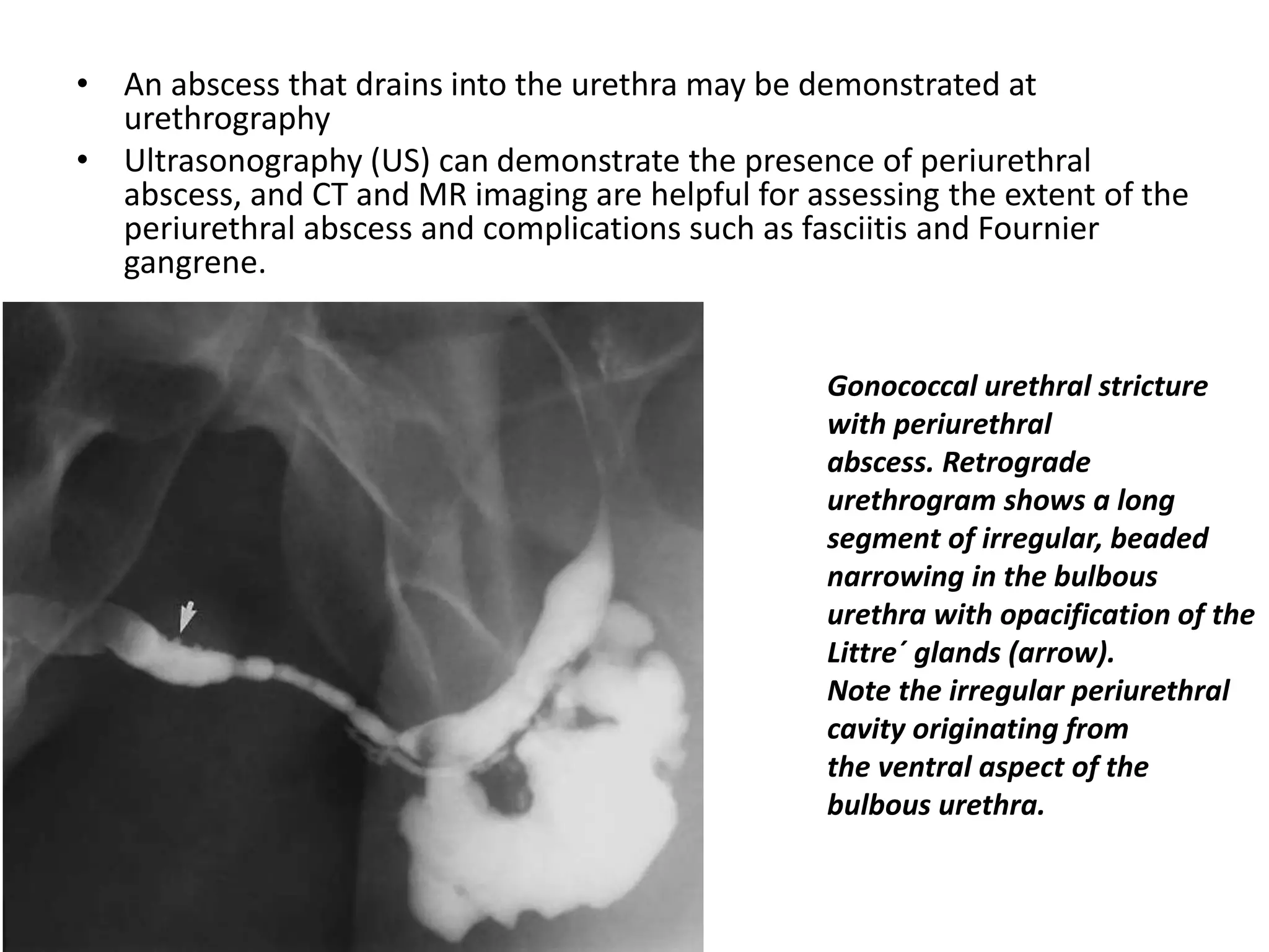 • An abscess that drains into the urethra may be demonstrated at
urethrography
• Ultrasonography (US) can demonstrate the presence of periurethral
abscess, and CT and MR imaging are helpful for assessing the extent of the
periurethral abscess and complications such as fasciitis and Fournier
gangrene.
Gonococcal urethral stricture
with periurethral
abscess. Retrograde
urethrogram shows a long
segment of irregular, beaded
narrowing in the bulbous
urethra with opacification of the
Littre´ glands (arrow).
Note the irregular periurethral
cavity originating from
the ventral aspect of the
bulbous urethra.
 